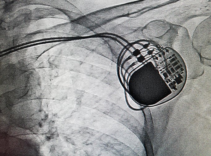 Dies ist ein Röntgenbild von einem Herzschrittmacher im Brustkorb eines Patienten.