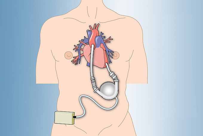 Dies ist eine Illustration zur Lage des künstlichen Herzens im Körper.