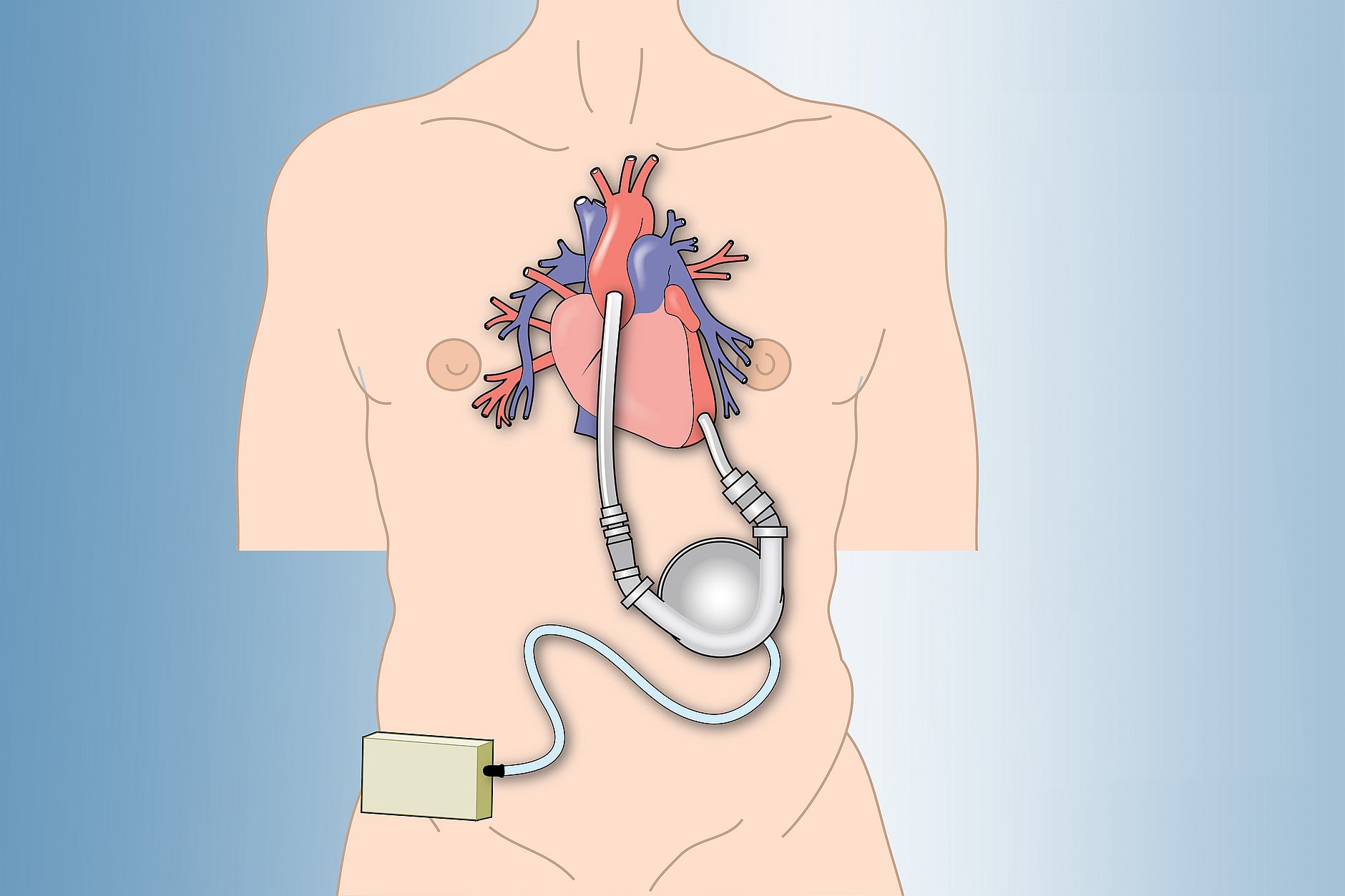 HGZ | Kunstherz LVAD Dies ist eine Illustration zur Lage des künstlichen Herzens im Körper.